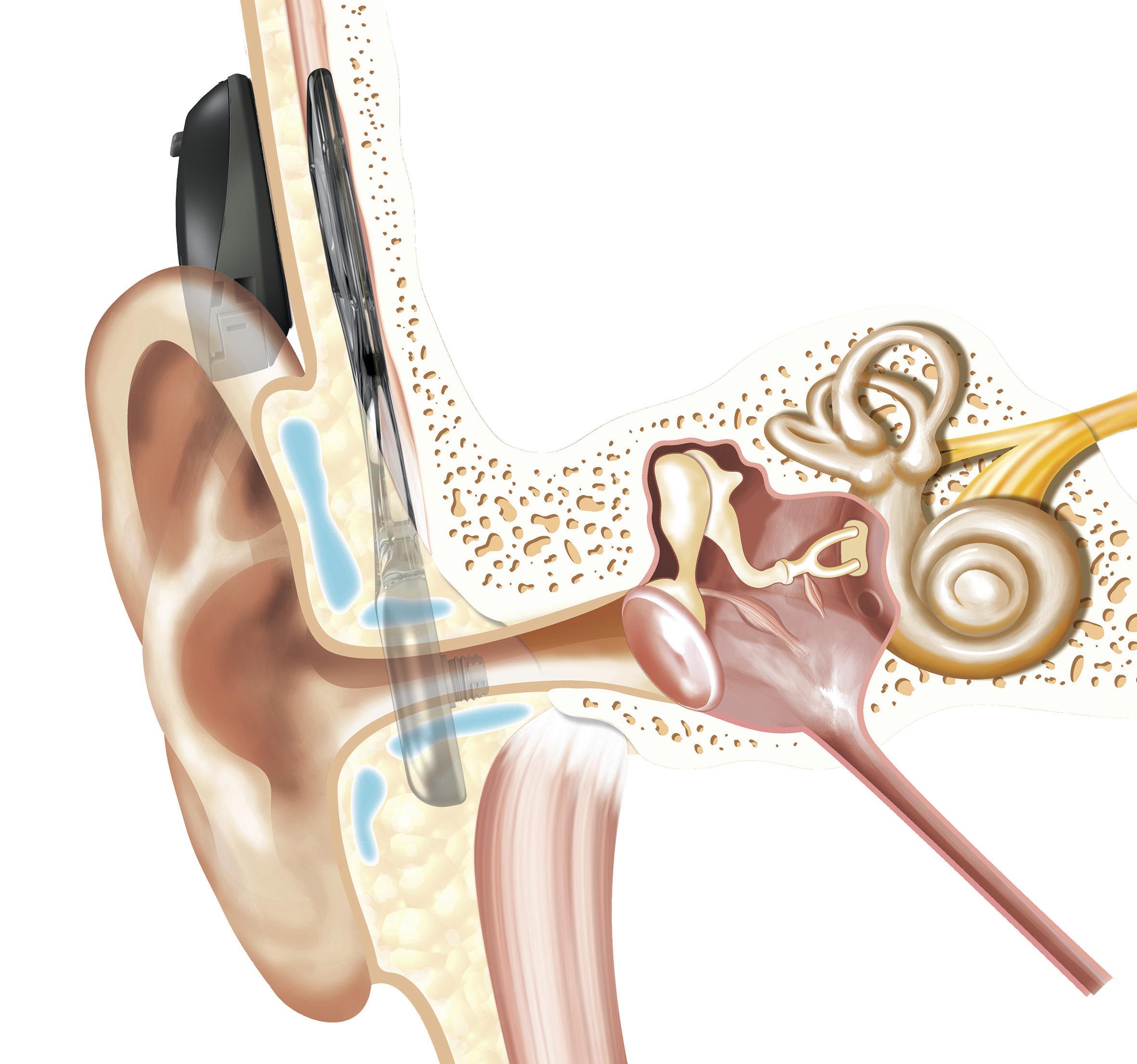 Grafik zeigt Cochlea-Implantat im Ohr